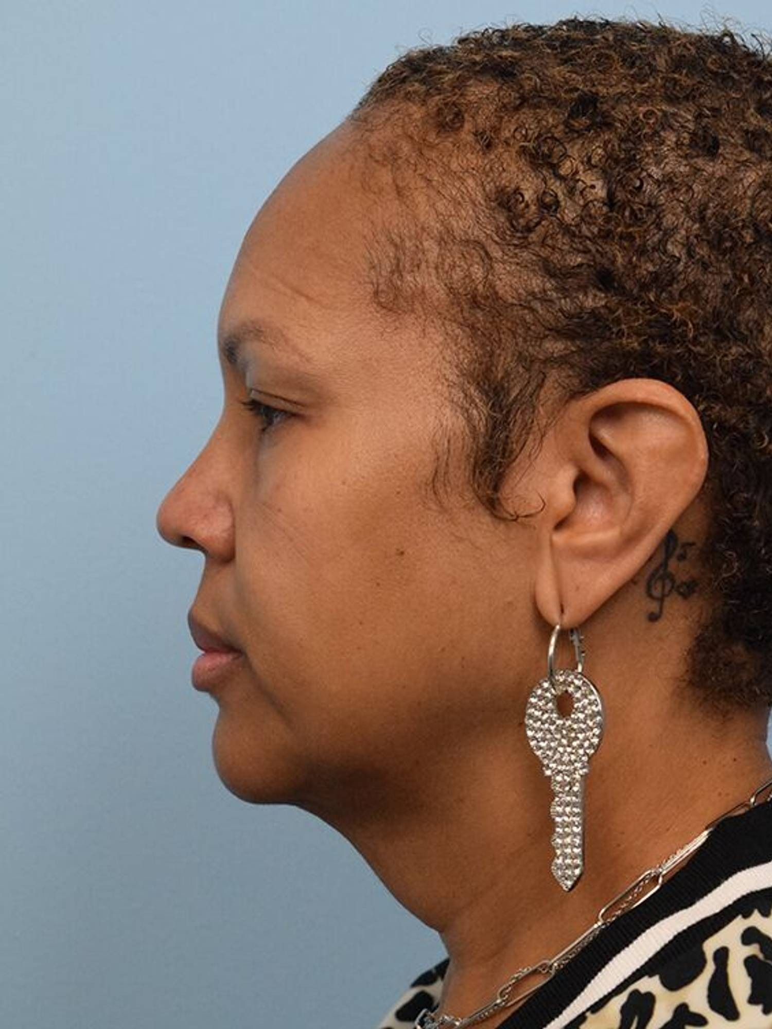 Deep Plane Necklift Before & After Image