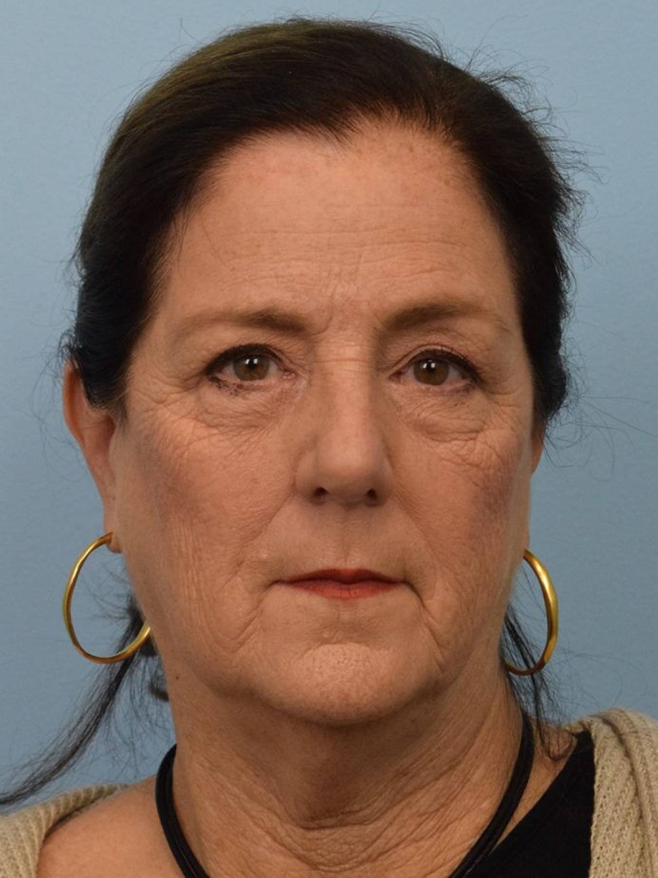 Deep Plane Necklift Before & After Image