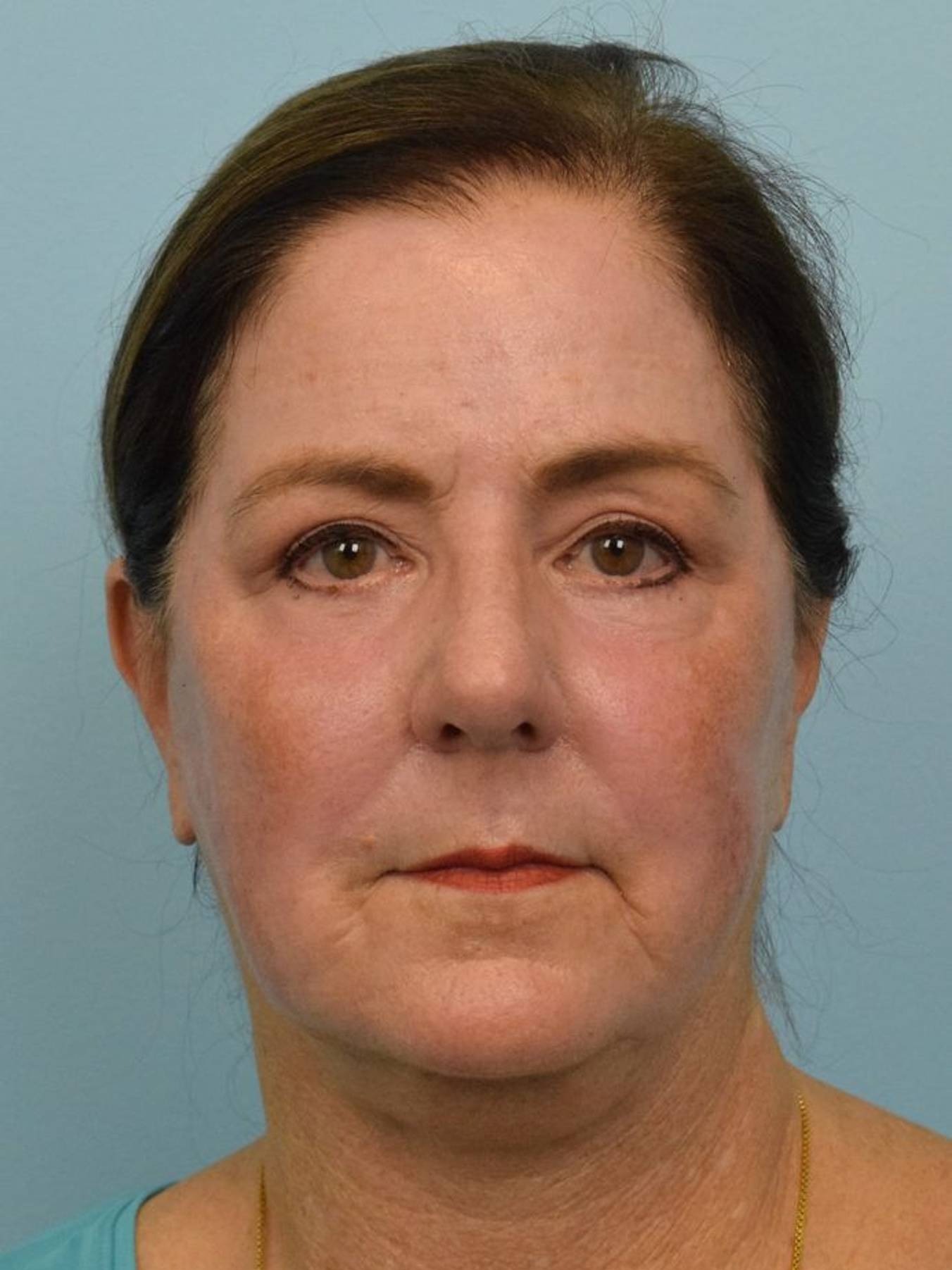 Deep Plane Necklift Before & After Image