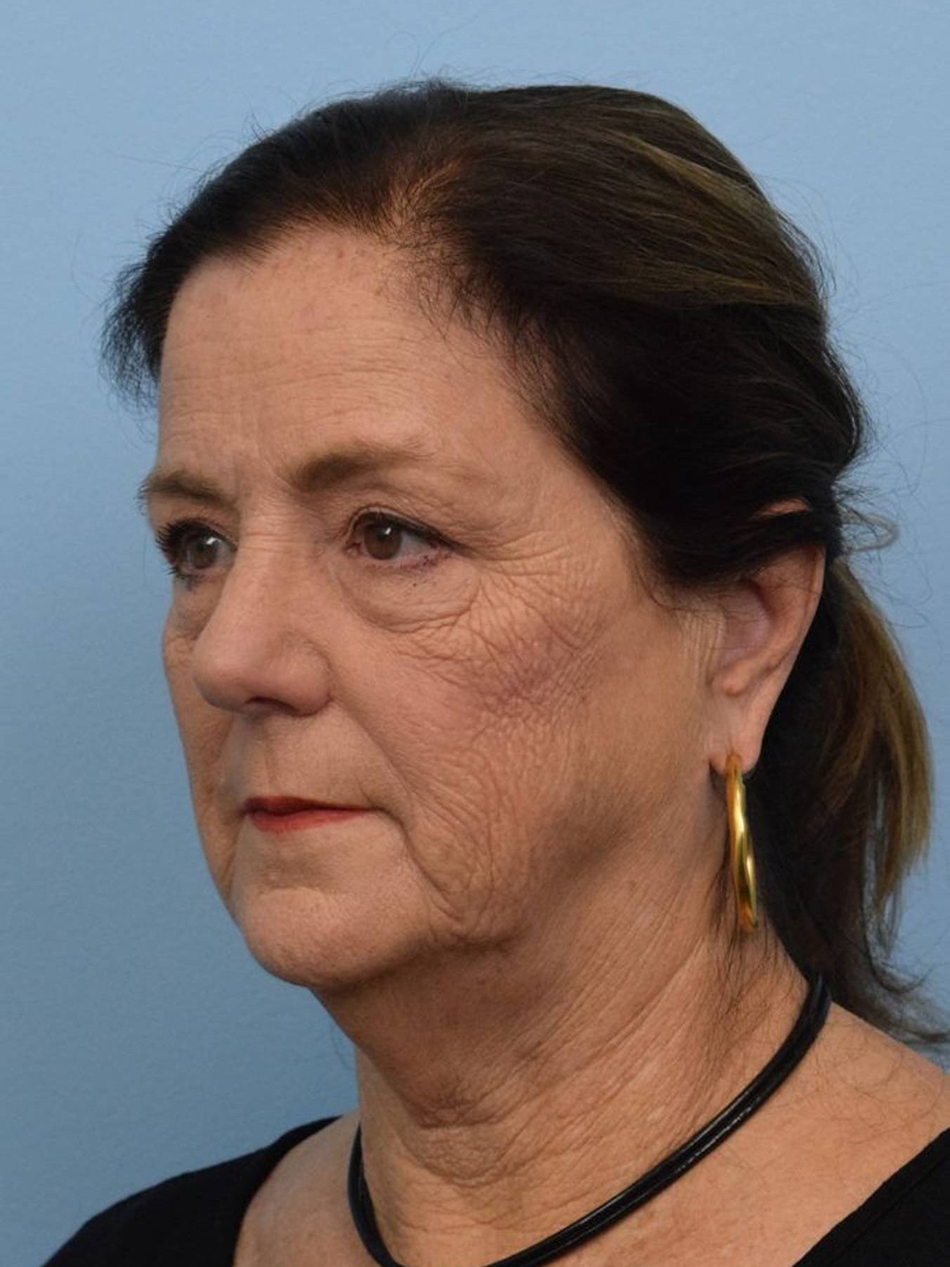 Deep Plane Necklift Before & After Image