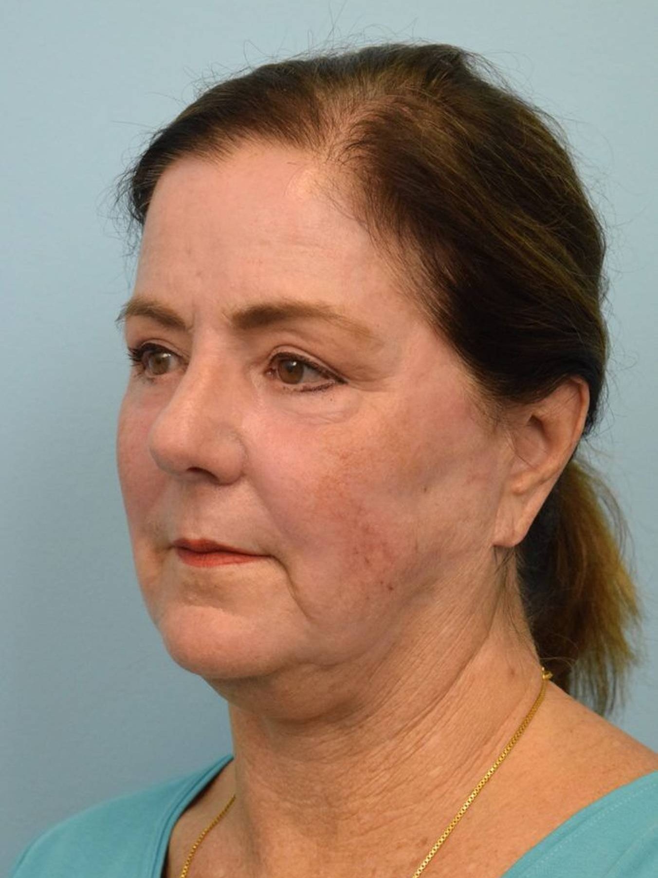 Deep Plane Necklift Before & After Image