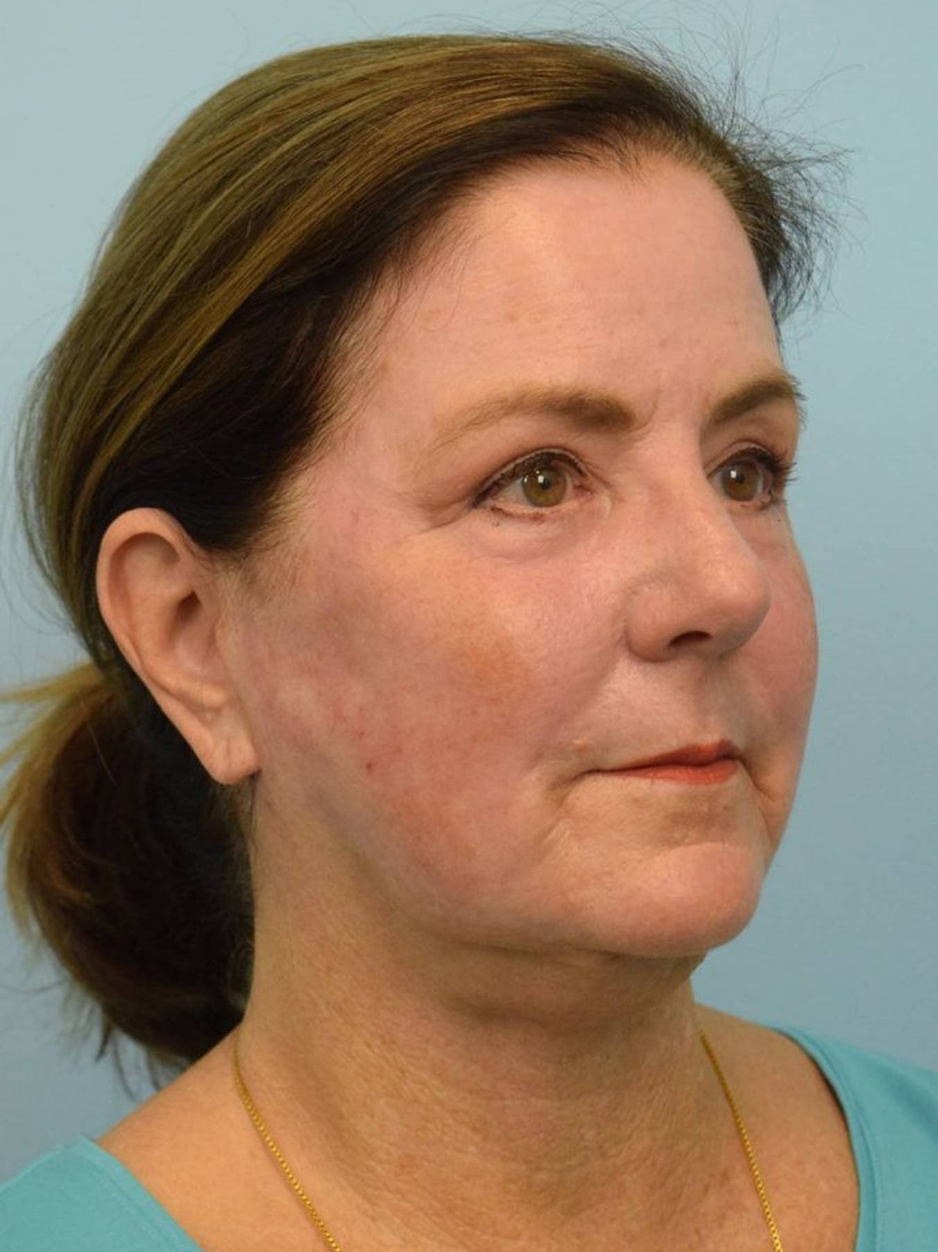 Deep Plane Necklift Before & After Image