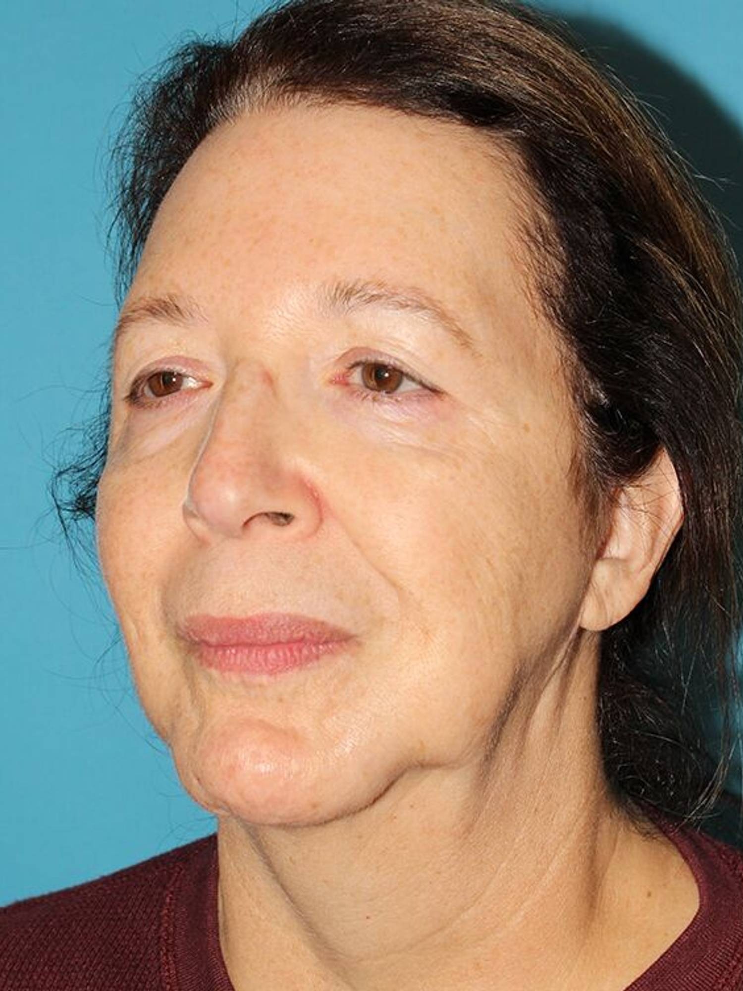 Deep Plane Necklift Before & After Image