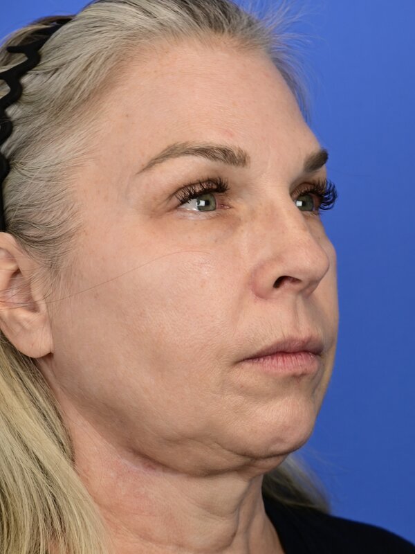 Deep plane necklift Before & After Image