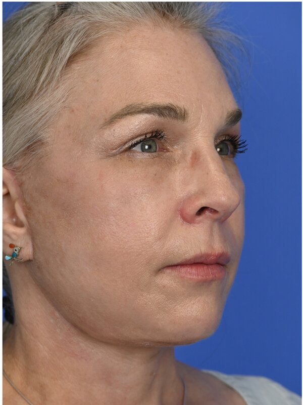 Deep plane necklift Before & After Image