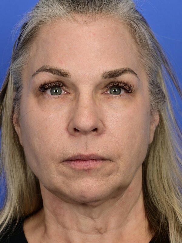 Deep plane necklift Before & After Image