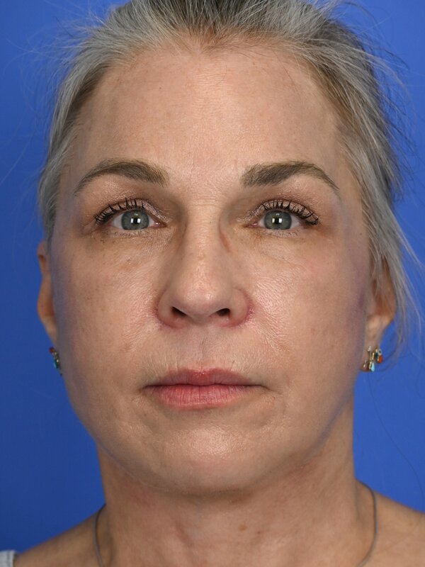 Deep plane necklift Before & After Image