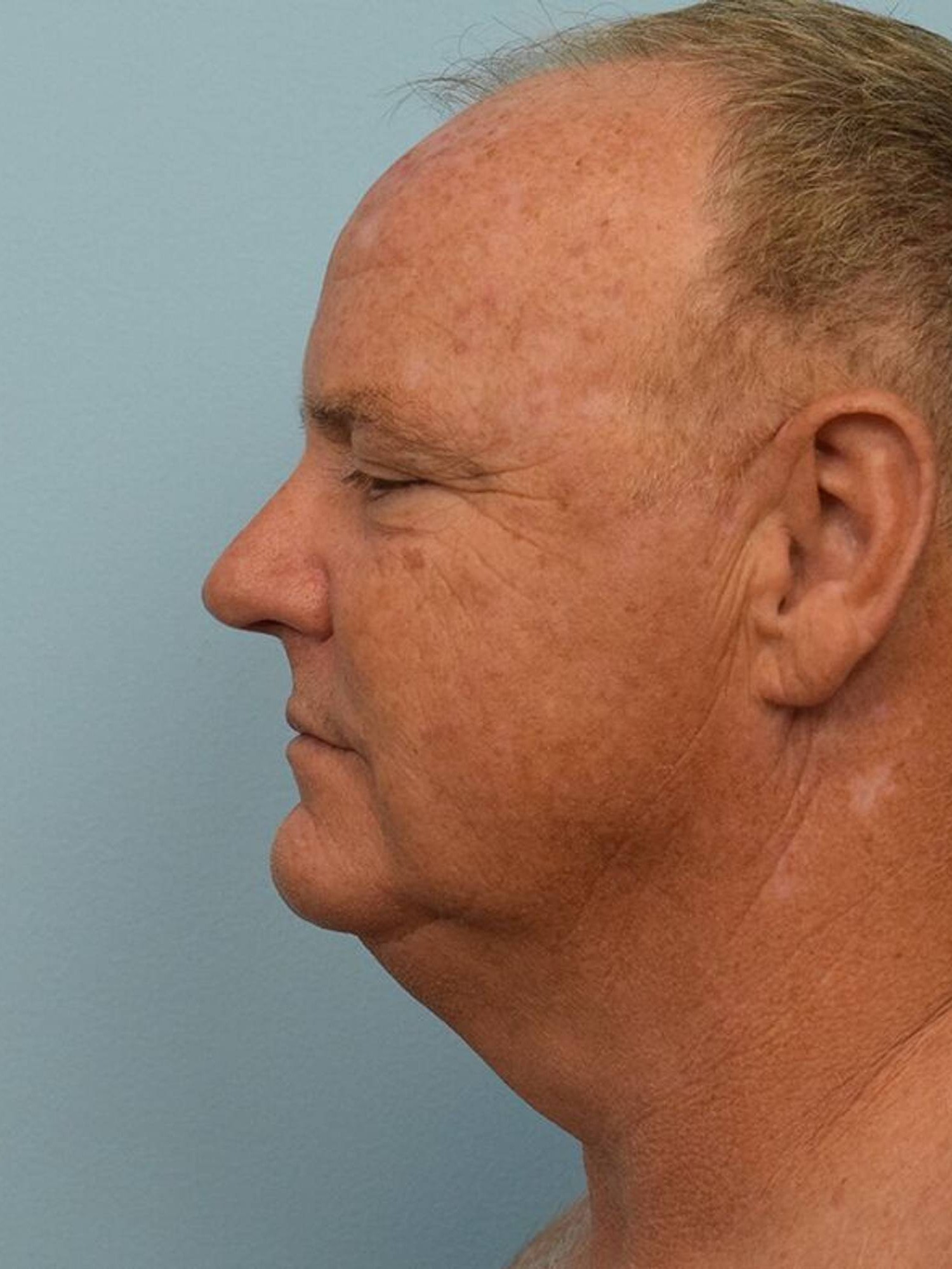 Deep Plane Necklift Before & After Image