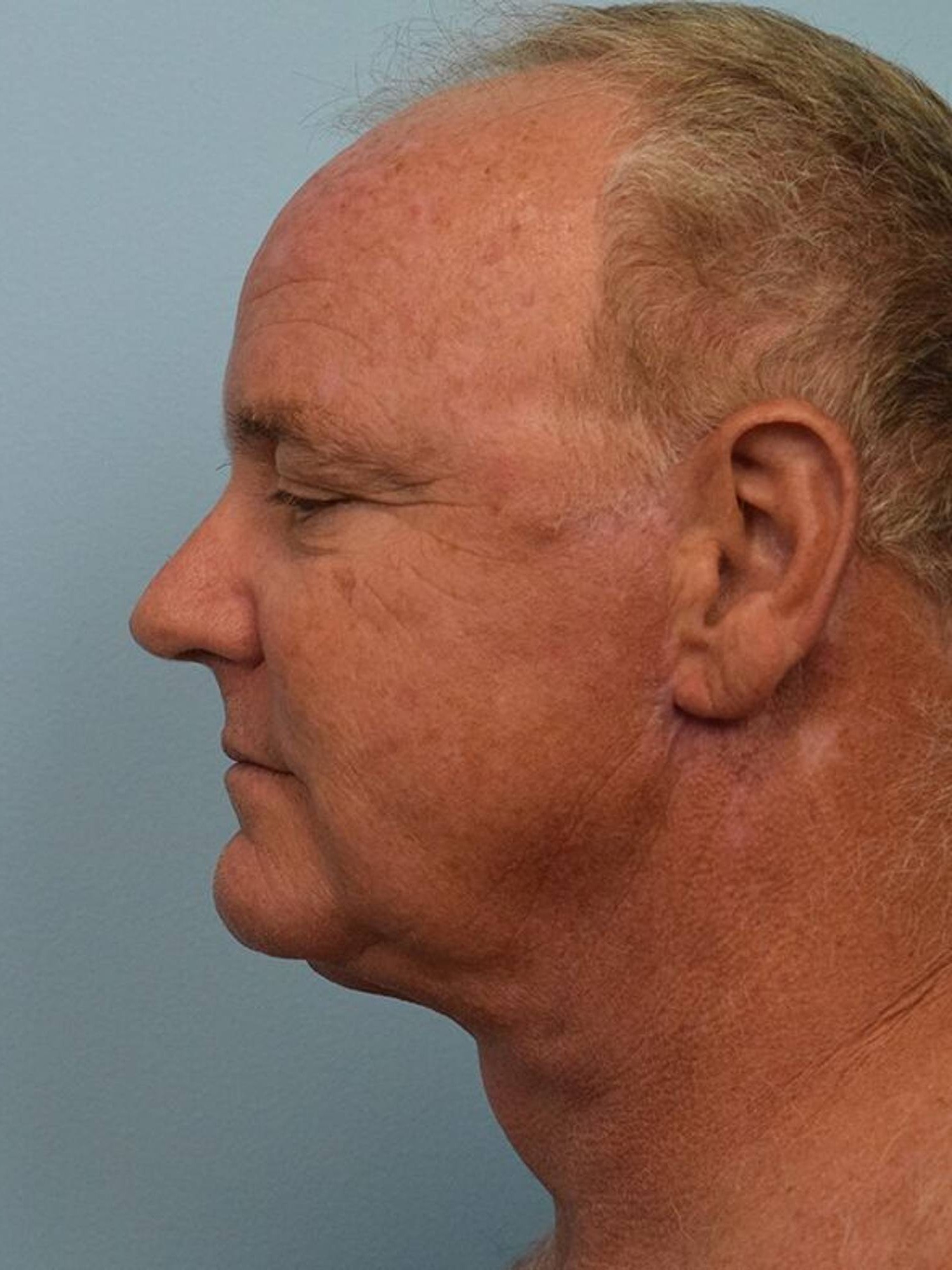Deep Plane Necklift Before & After Image