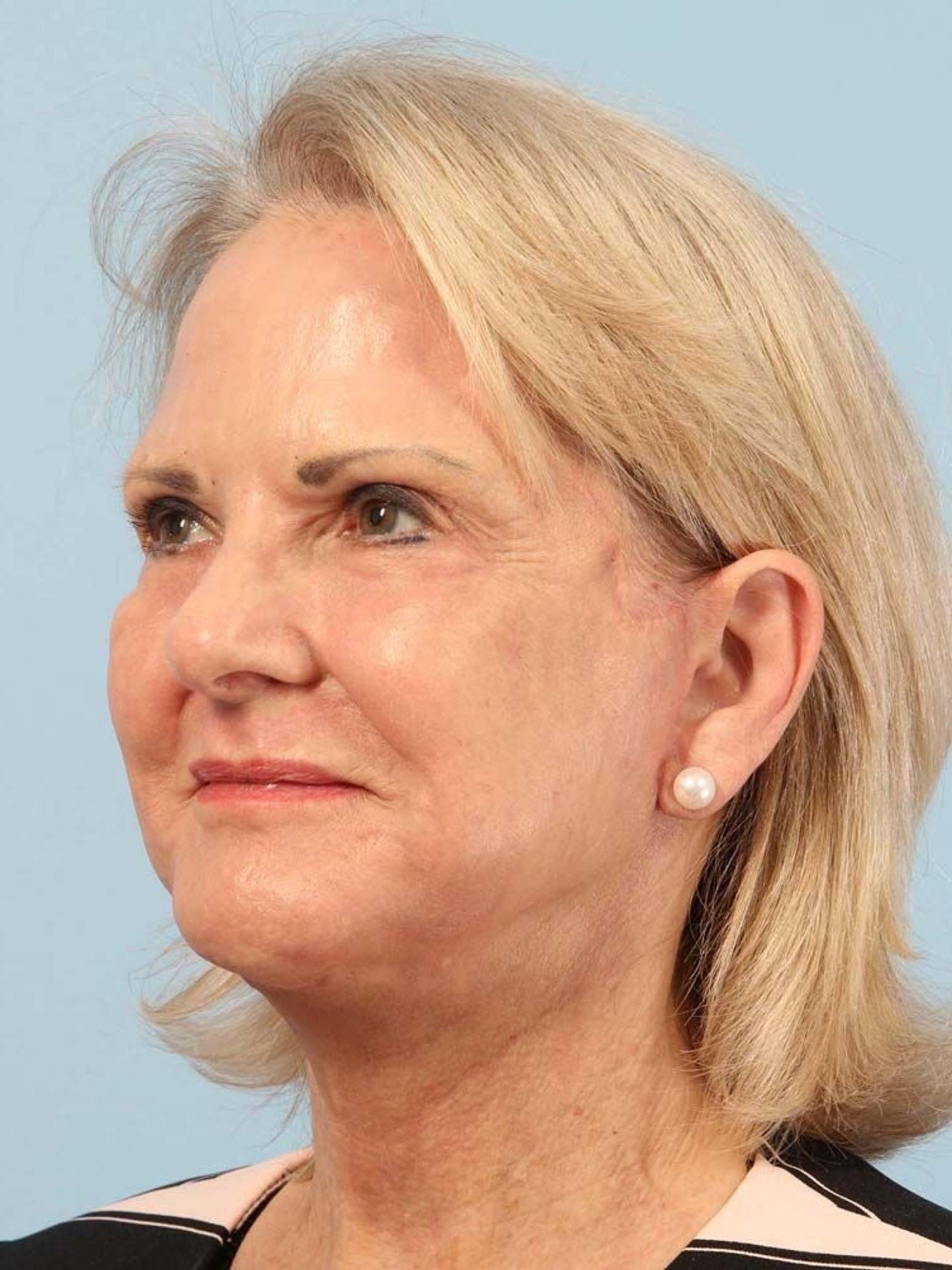 Deep Plane Necklift Before & After Image