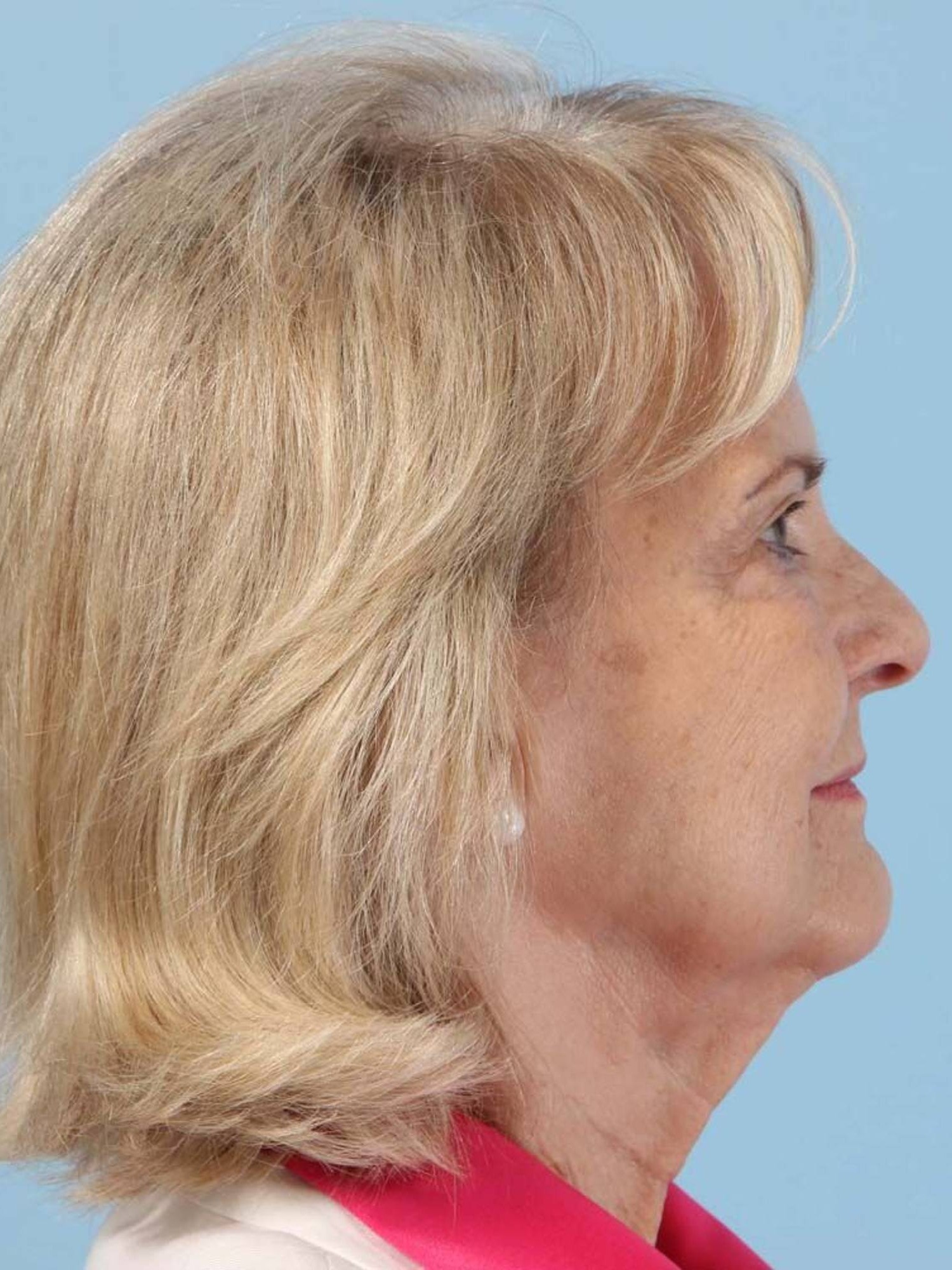 Deep Plane Necklift Before & After Image