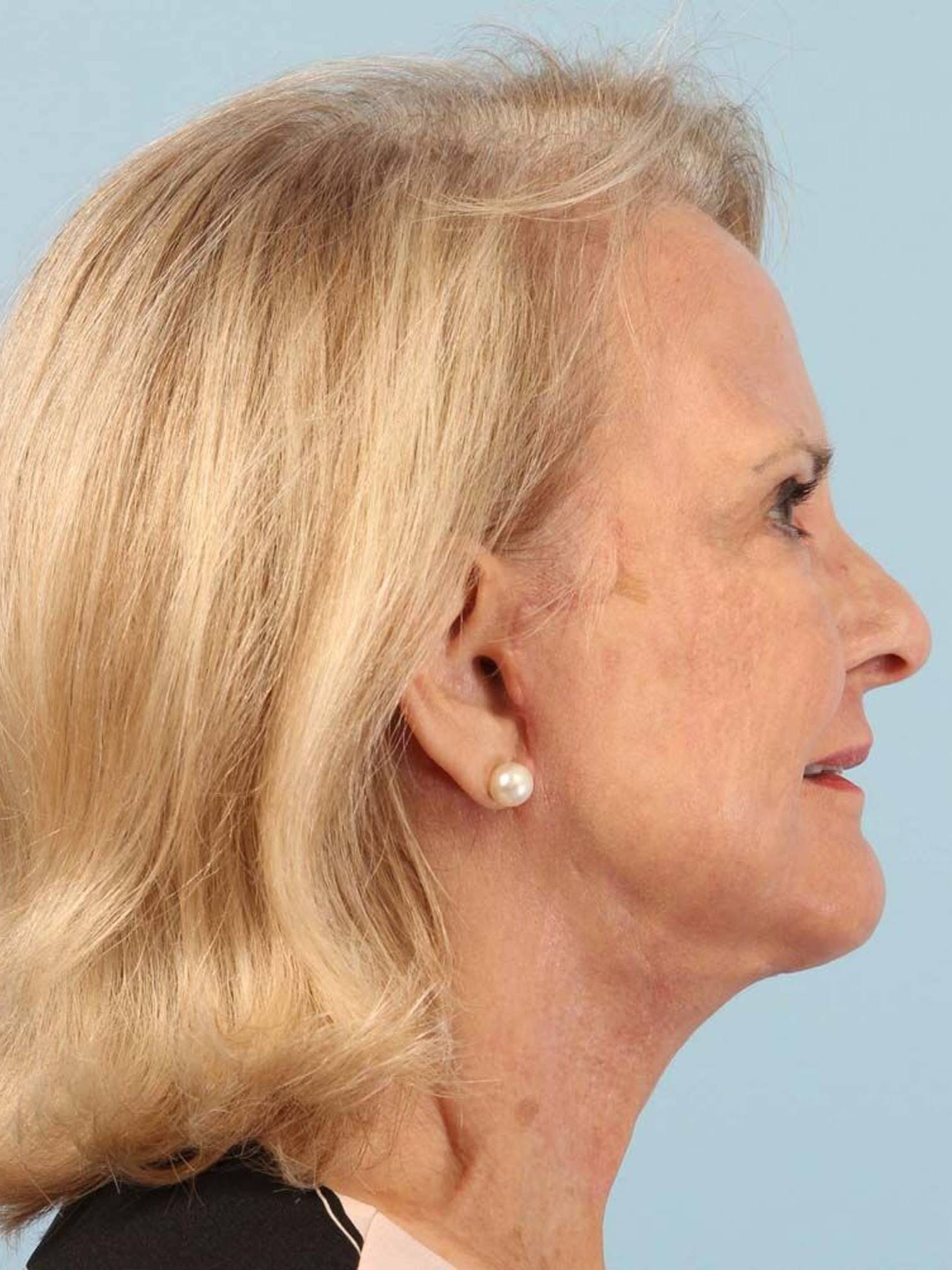 Deep Plane Necklift Before & After Image
