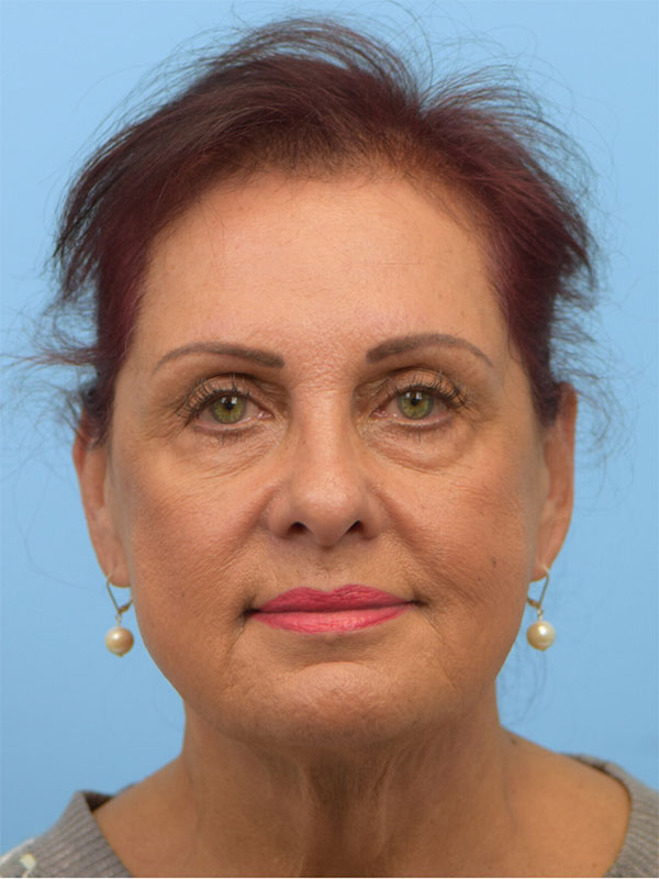 Deep Plane Necklift Before & After Image
