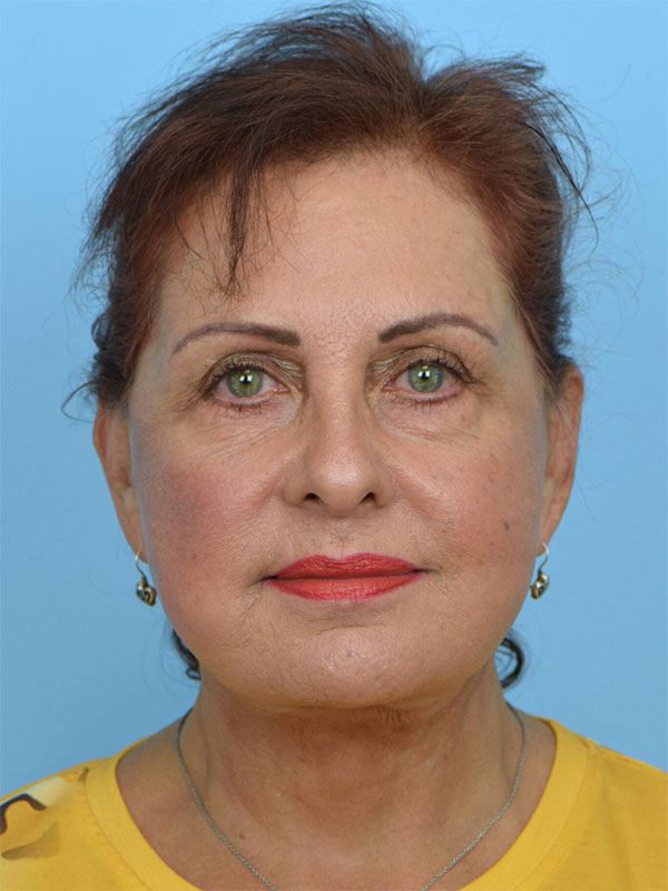 Deep Plane Necklift Before & After Image