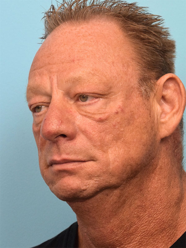 Deep Plane Necklift Before & After Image