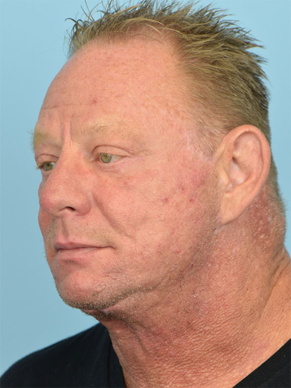 Deep Plane Necklift Before & After Image