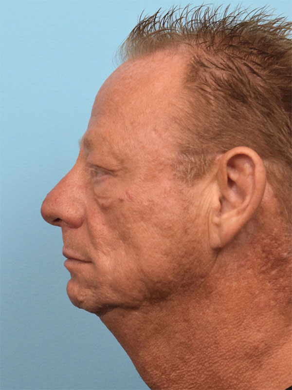 Deep Plane Necklift Before & After Image