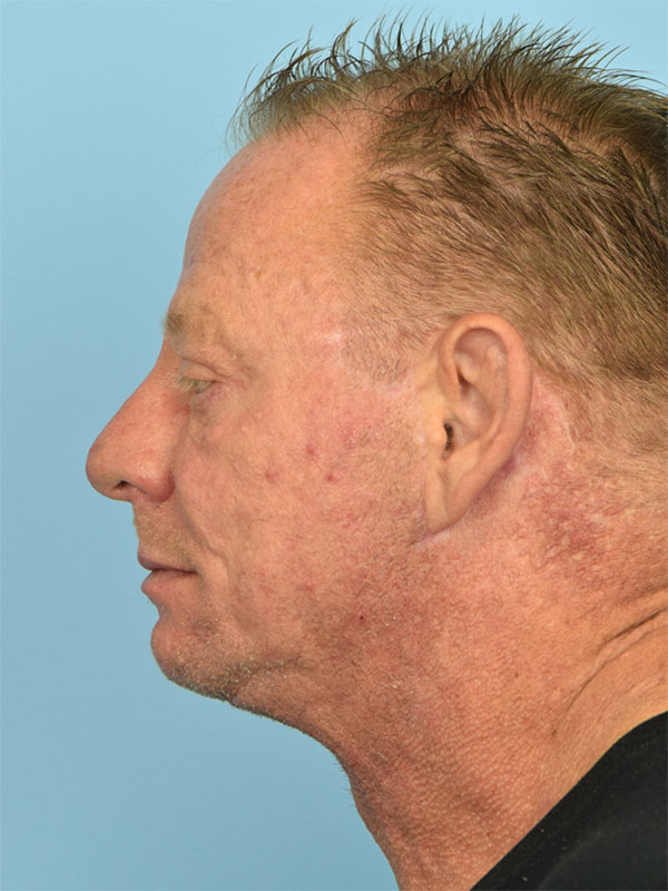 Deep Plane Necklift Before & After Image