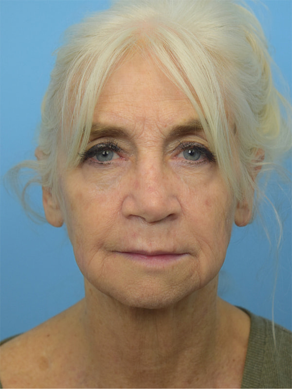 Deep Plane Necklift Before & After Image