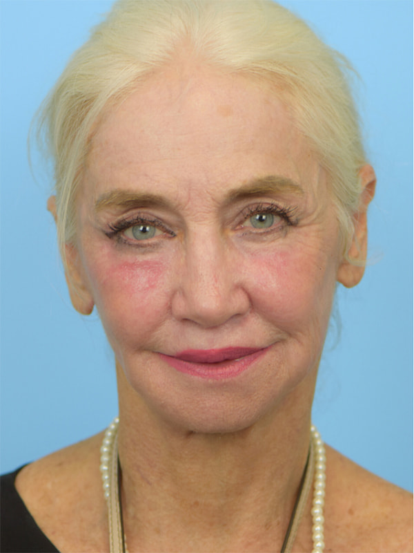 Deep Plane Necklift Before & After Image