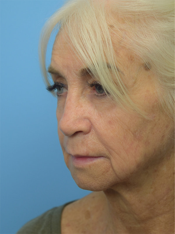 Deep Plane Necklift Before & After Image