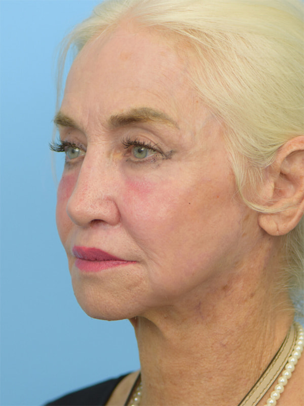 Deep Plane Necklift Before & After Image