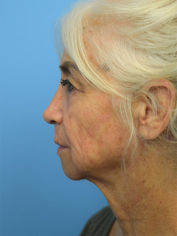 Deep Plane Necklift Before & After Image