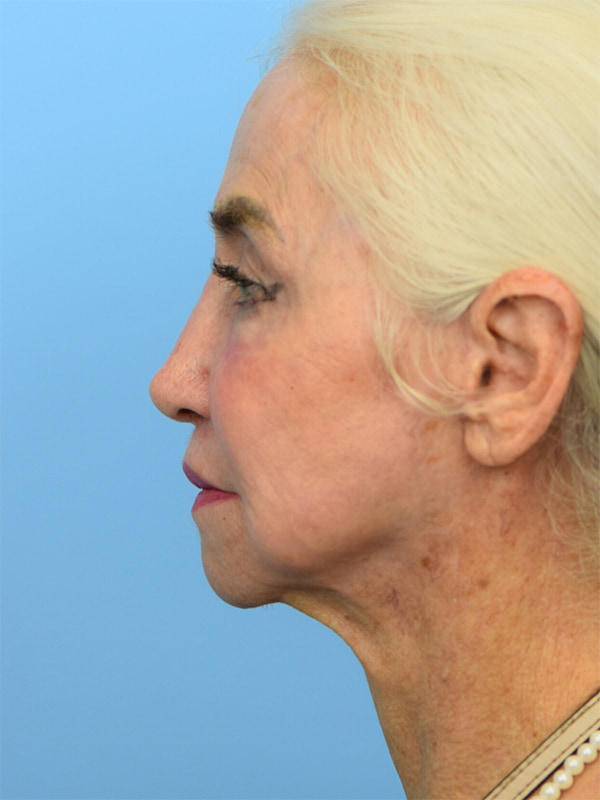 Deep Plane Necklift Before & After Image