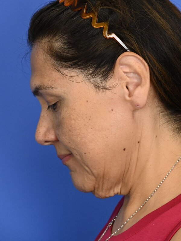 Deep Plane Necklift Before & After Image