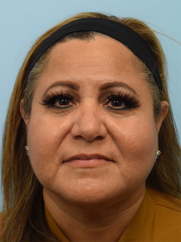 Deep Plane Necklift Before & After Image