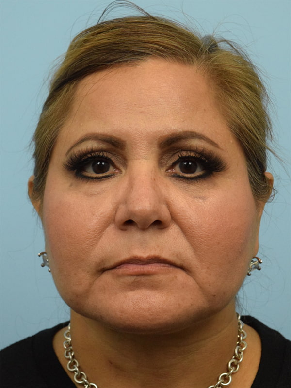 Deep Plane Necklift Before & After Image