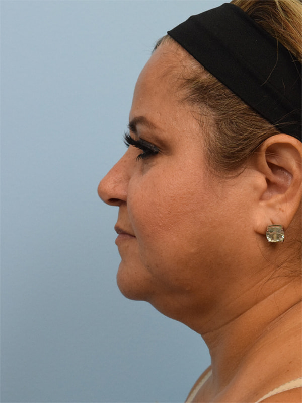Deep Plane Necklift Before & After Image