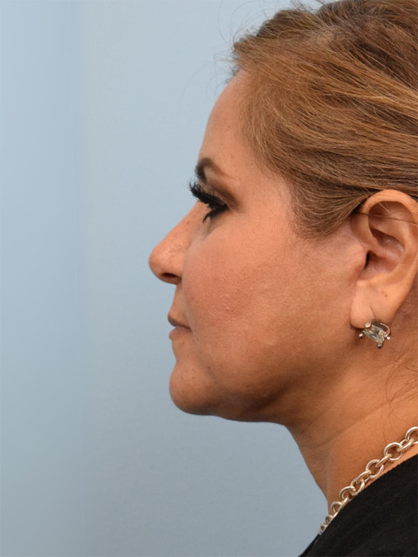 Deep Plane Necklift Before & After Image