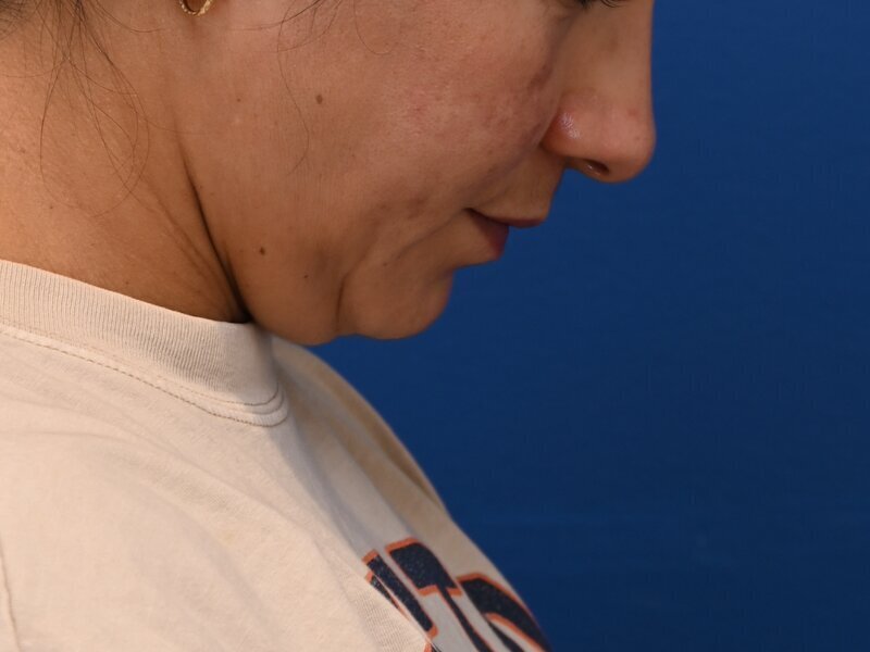 Deep Plane Necklift Before & After Image