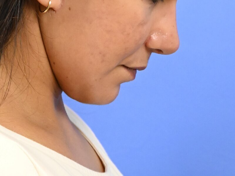 Deep Plane Necklift Before & After Image
