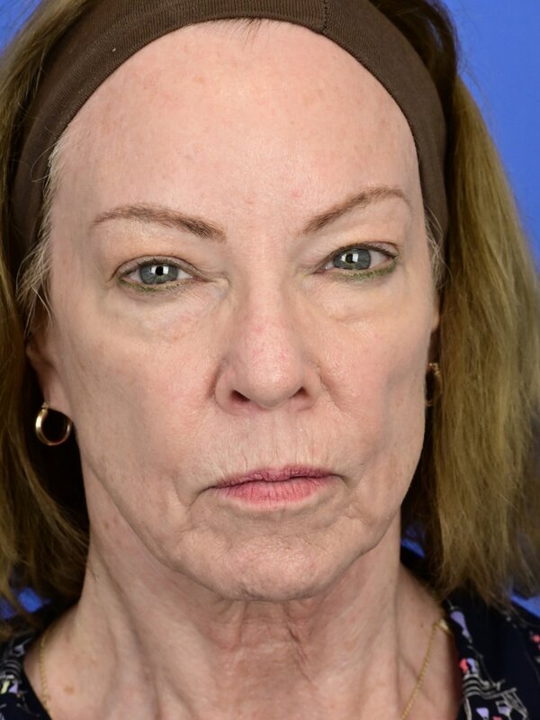 Deep Plane Necklift Before & After Image