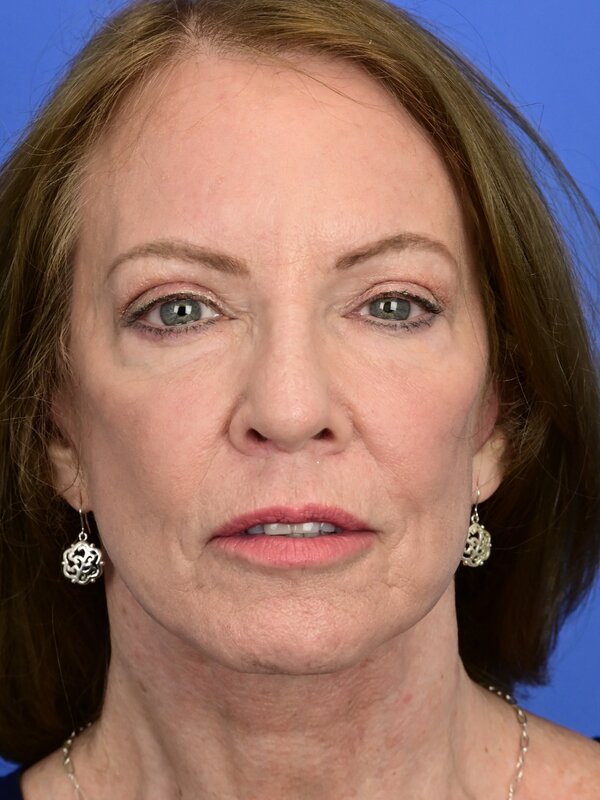 Deep Plane Necklift Before & After Image