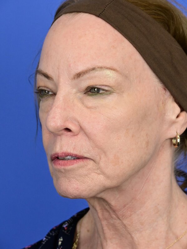Deep Plane Necklift Before & After Image