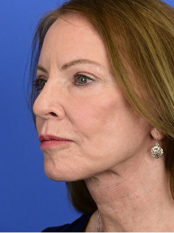 Deep Plane Necklift Before & After Image