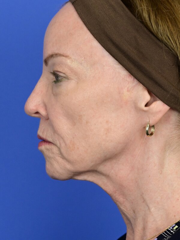 Deep Plane Necklift Before & After Image