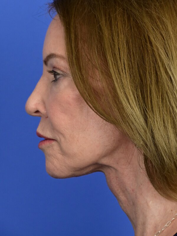 Deep Plane Necklift Before & After Image