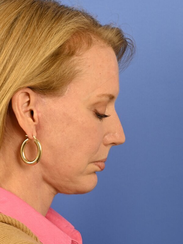 Deep Plane Necklift Before & After Image