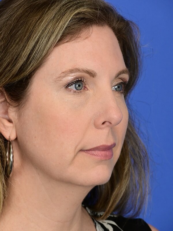 Deep Plane Necklift Before & After Image