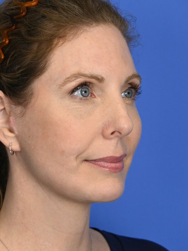 Deep Plane Necklift Before & After Image