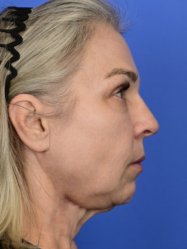 Deep Plane Necklift Before & After Image