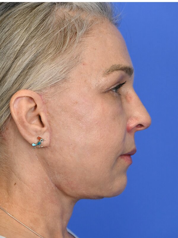 Deep Plane Necklift Before & After Image