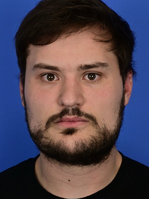 Deep Plane Necklift Before & After Image