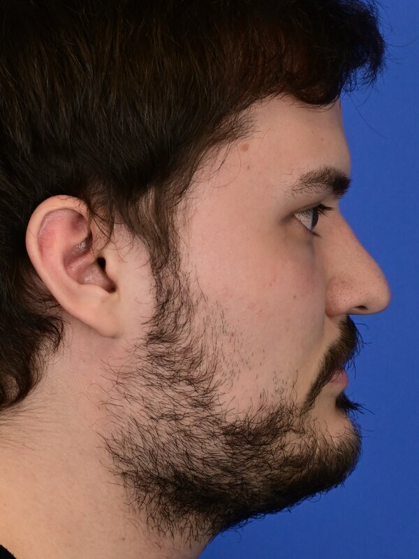 Deep Plane Necklift Before & After Image