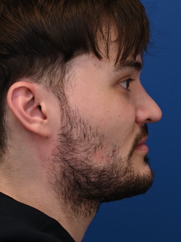 Deep Plane Necklift Before & After Image