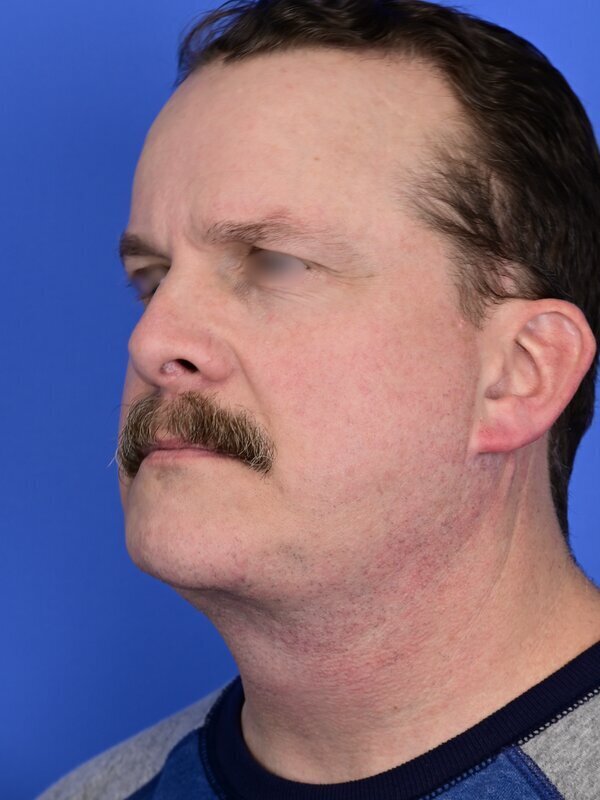 Deep Plane Necklift Before & After Image